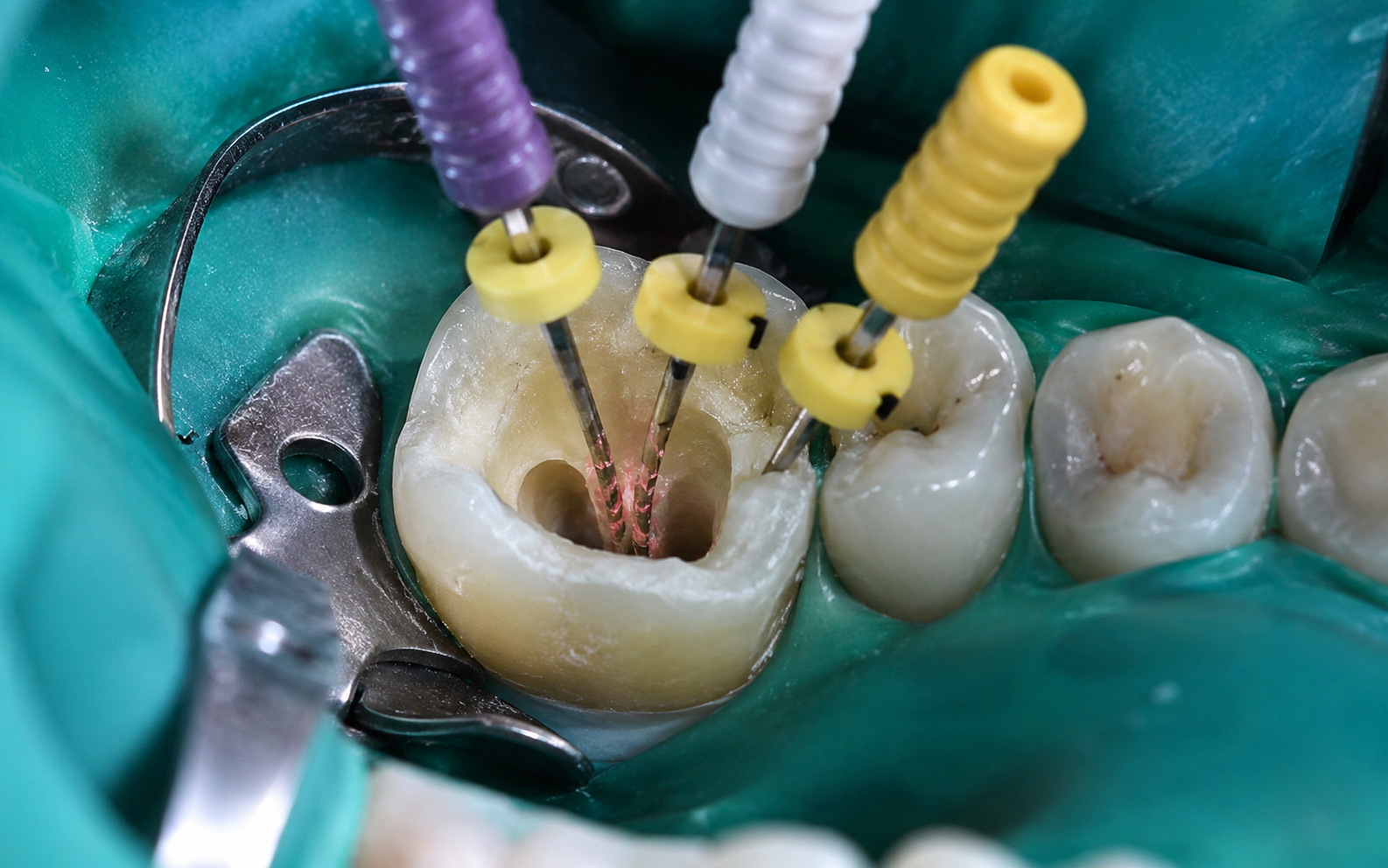 Endodonzia
